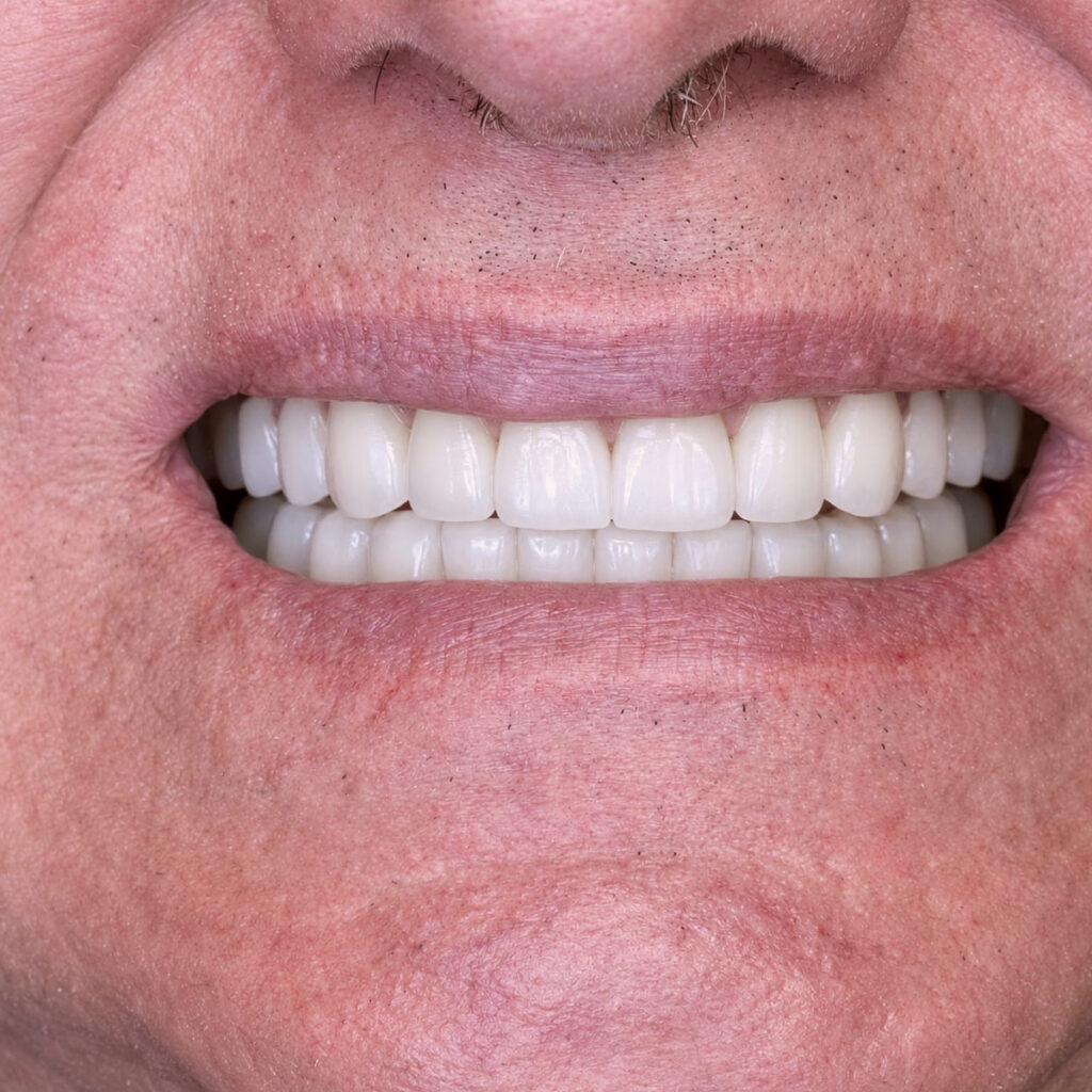 Aesthetic smile enhancement – po