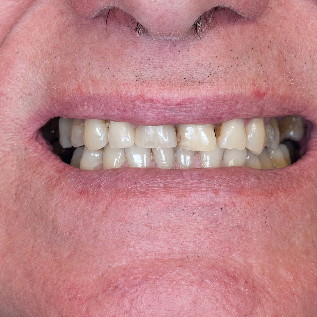 Aesthetic smile enhancement – pred